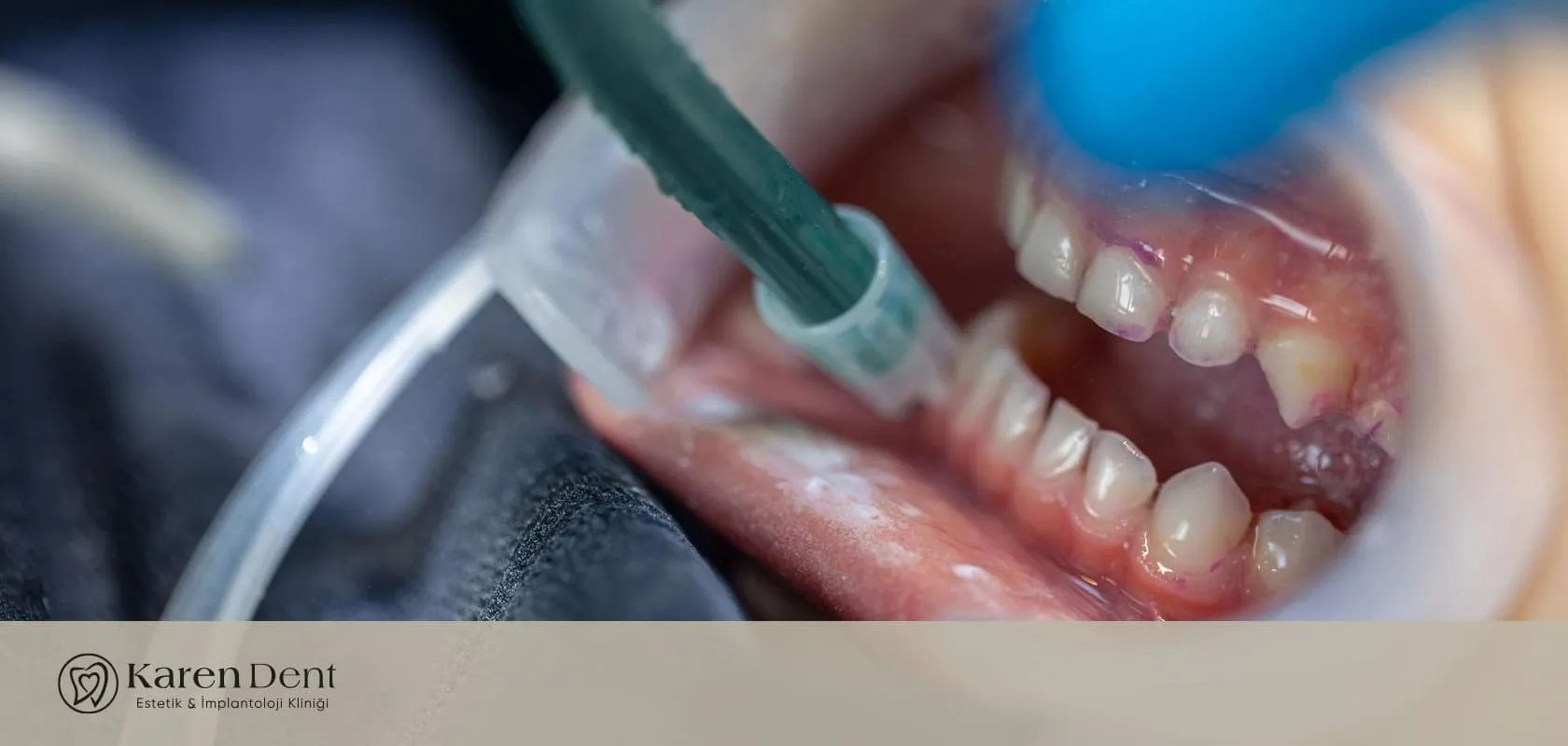 ataşehir ve istanbul'da diş eti çekilmesi tedavisi