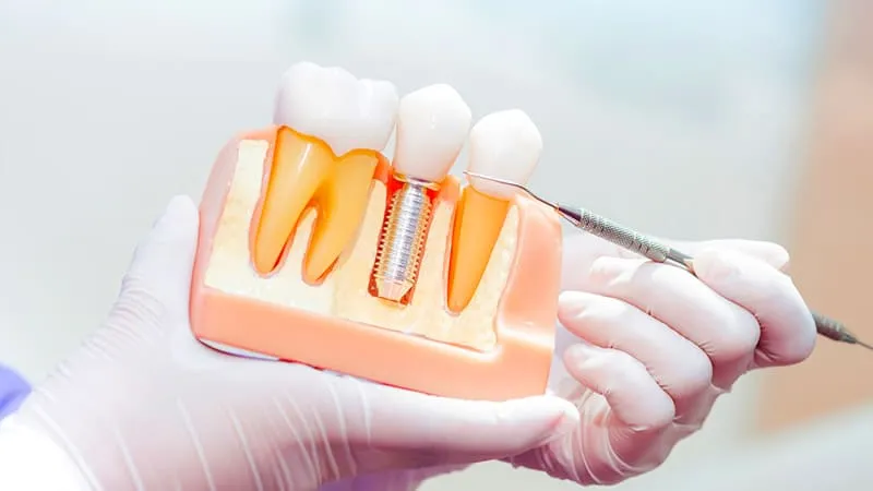 all on four implant tedavisi istanbul