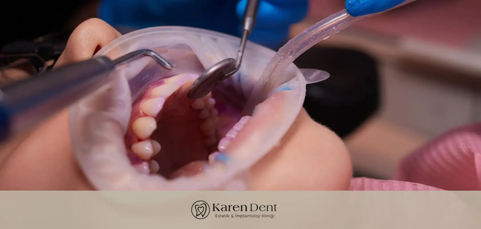 Diş Dolgusu Çeşitleri