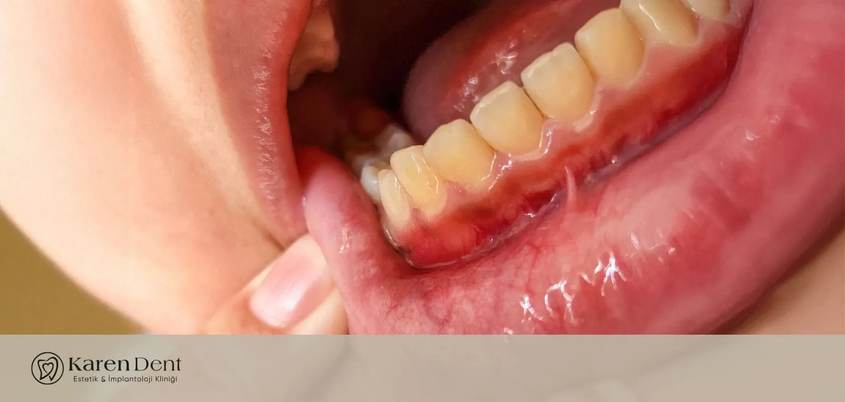 diş eti çekilmesi nedir