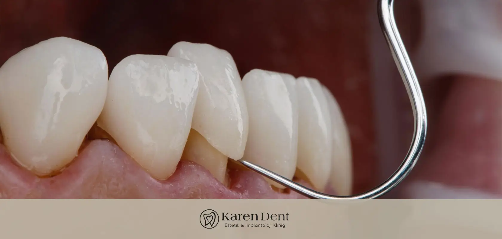 dis-kaplama-fiyatlari-2026