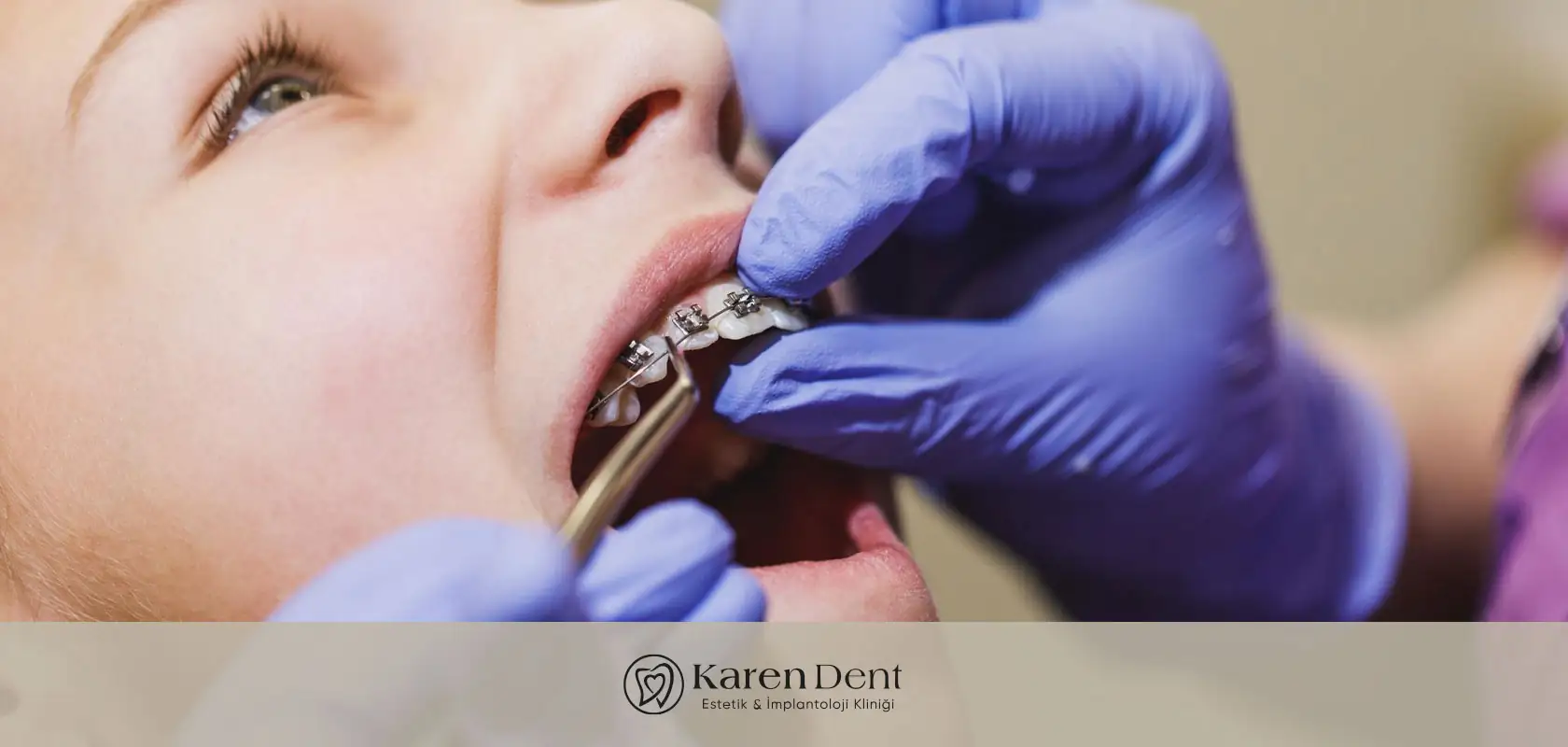 dis-teli-nasil-takilir