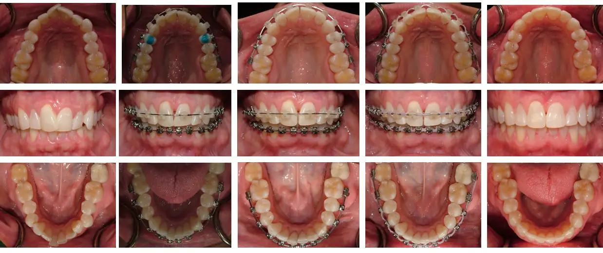 dis-teli-tedavisi-oncesi-ve-sonrasi
