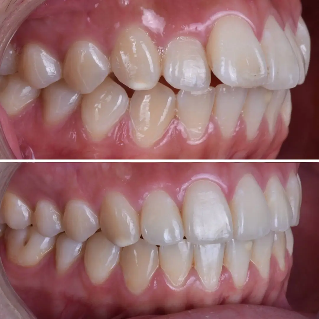 disteli-oncesi-sonrasi