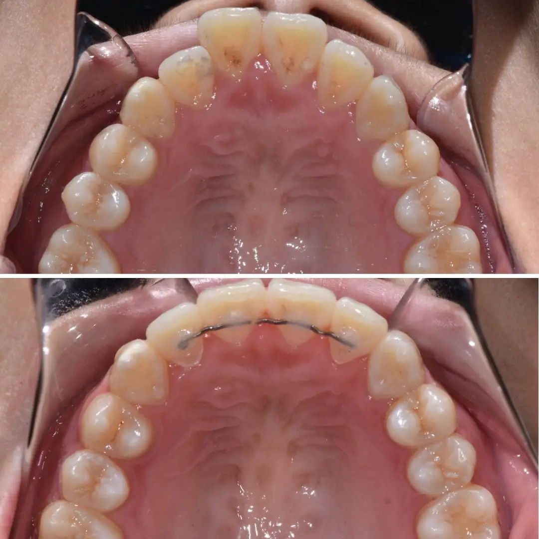 disteli-oncesi-sonrasi