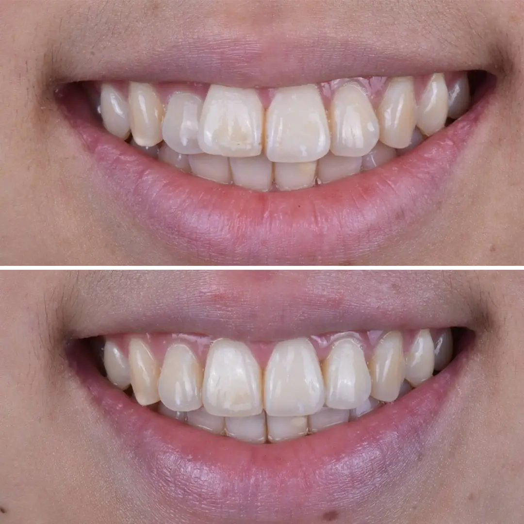 disteli-oncesi-sonrasi