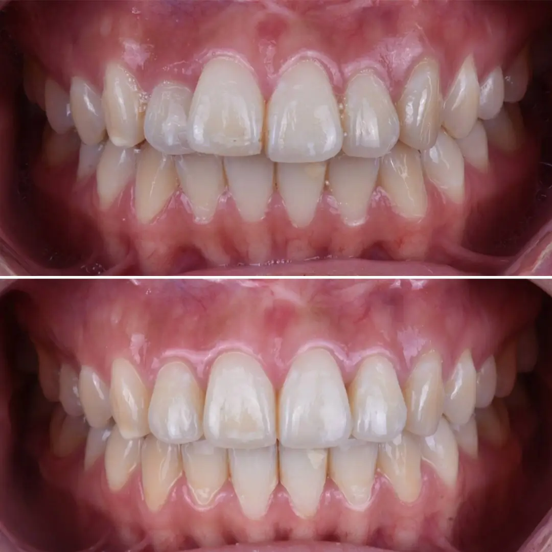 disteli-oncesi-sonrasi