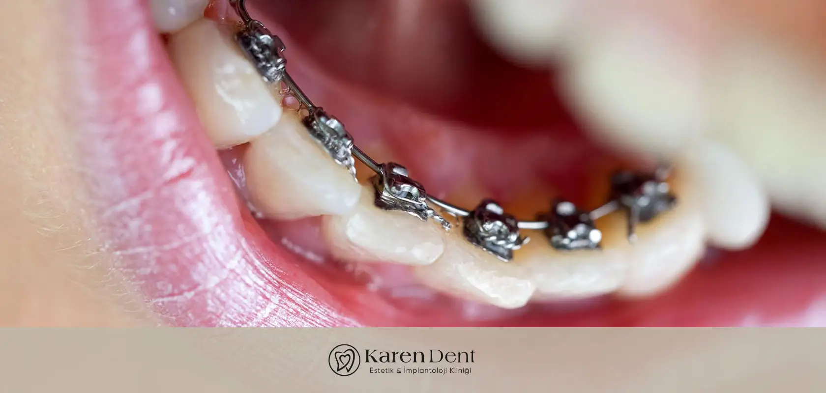 lingual-dis-teli-nedir