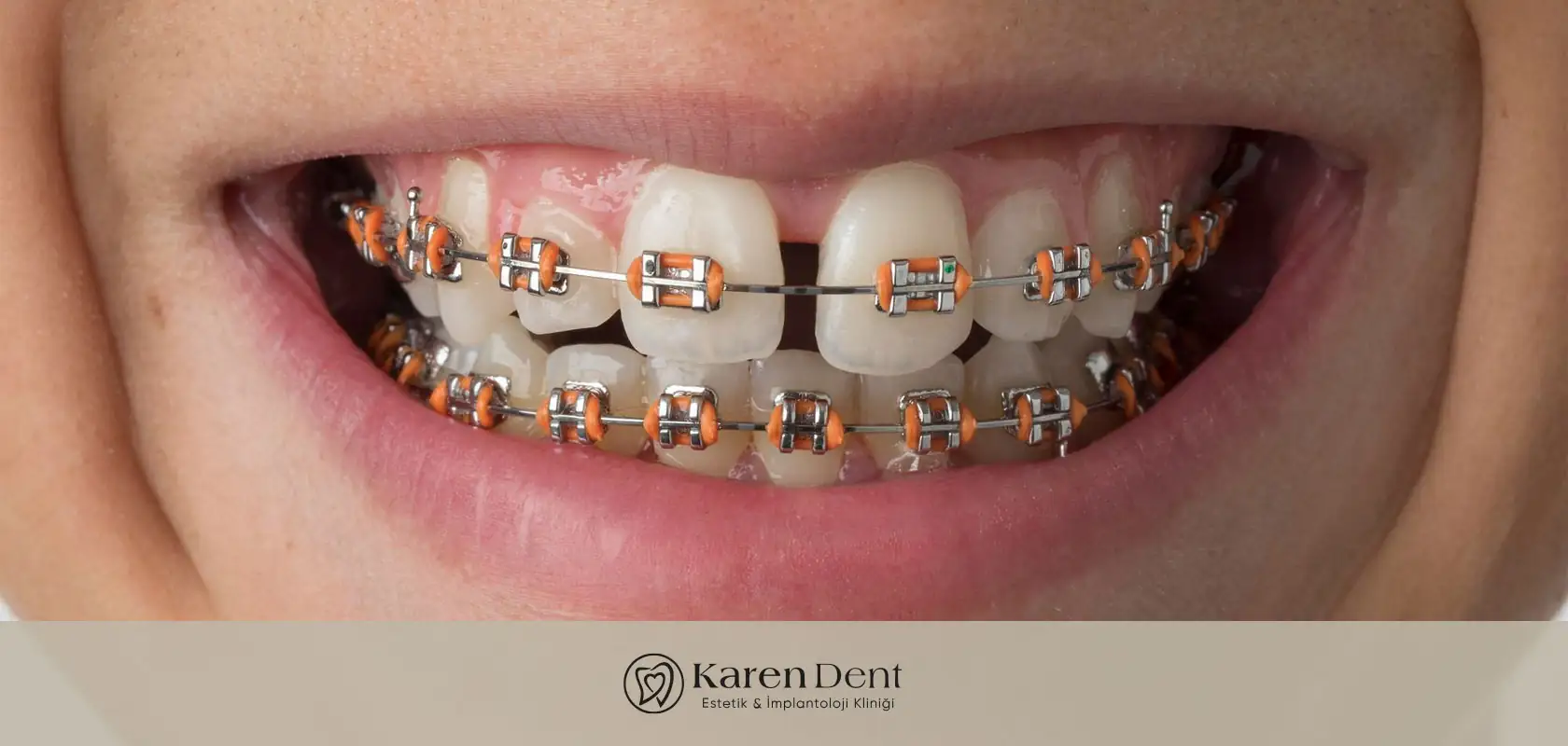 metal-dis-teli-nedir