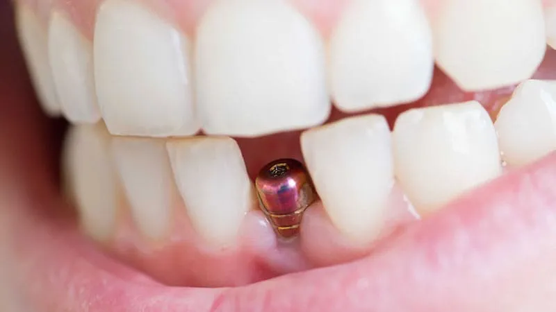 mini dental implant tedavisi farkı