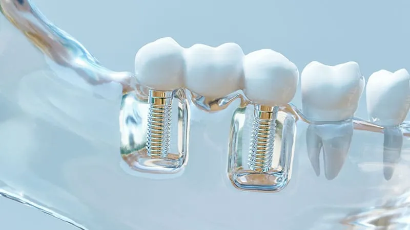 mini-dental-implantlar-hangi-durumda-tercih-edilir