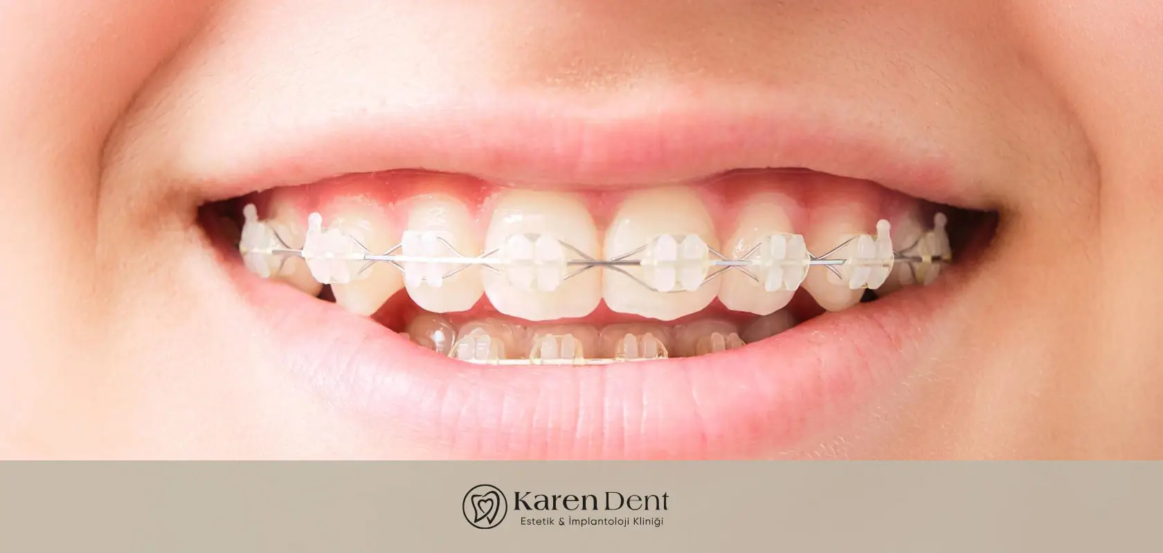 seramik-ve-safir-dis-teli-nedir